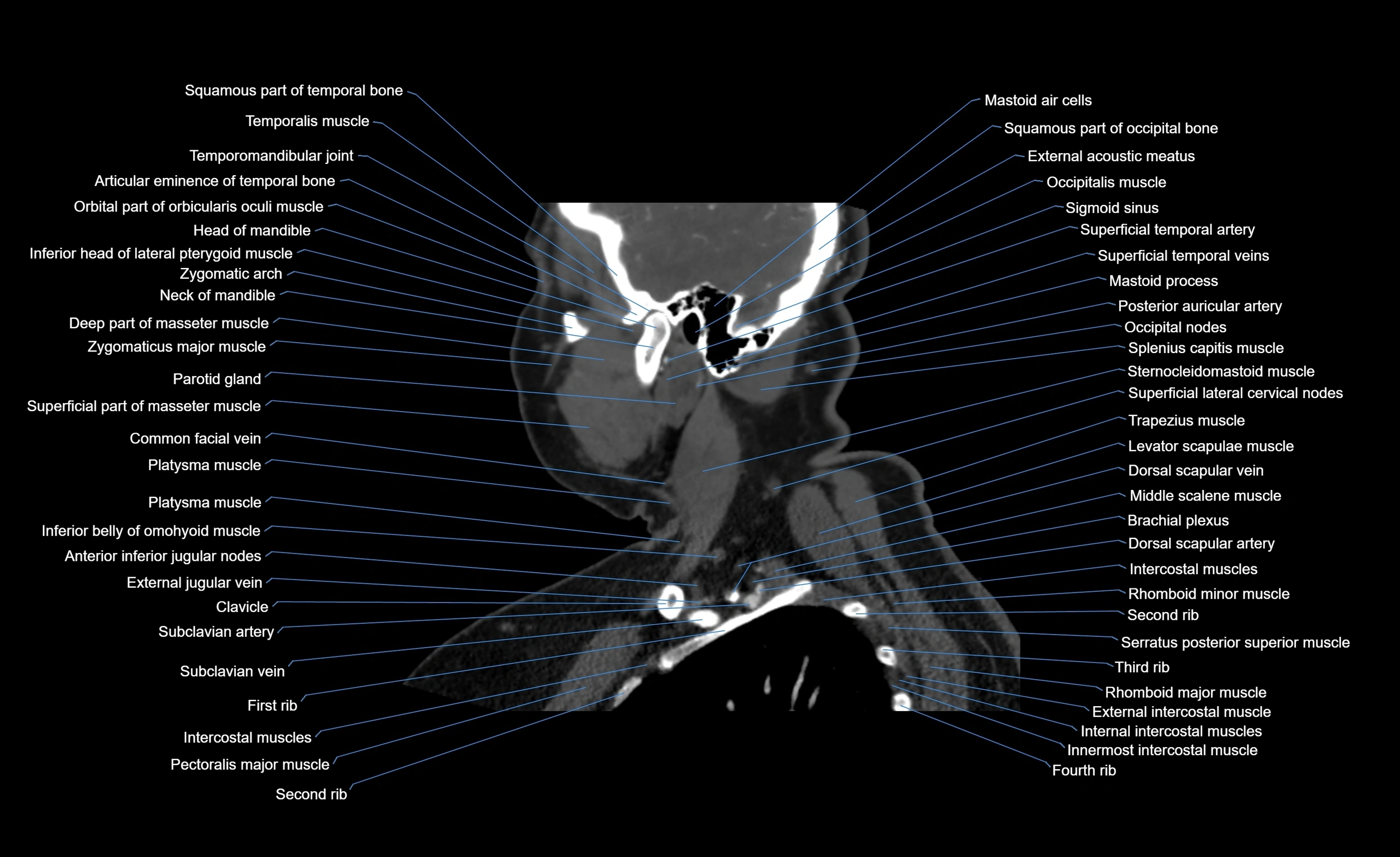 Neck CT sagittal cross sectional anatomy 3D  radiology  image-img-00001-00019.webp
